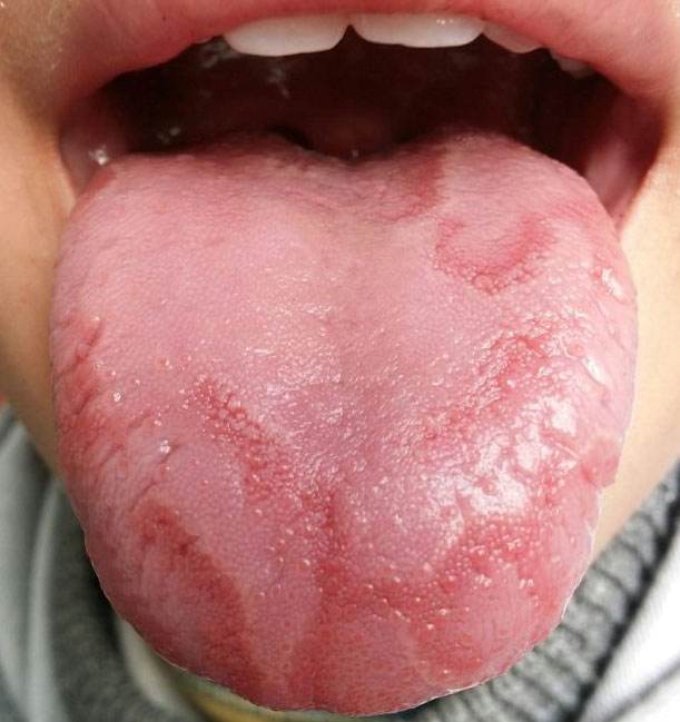 舌炎 治疗  1,地图舌:主要是由于脾胃湿热及气阴两虚,西医上讲主要是